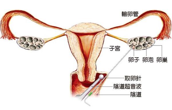 男性不孕不育