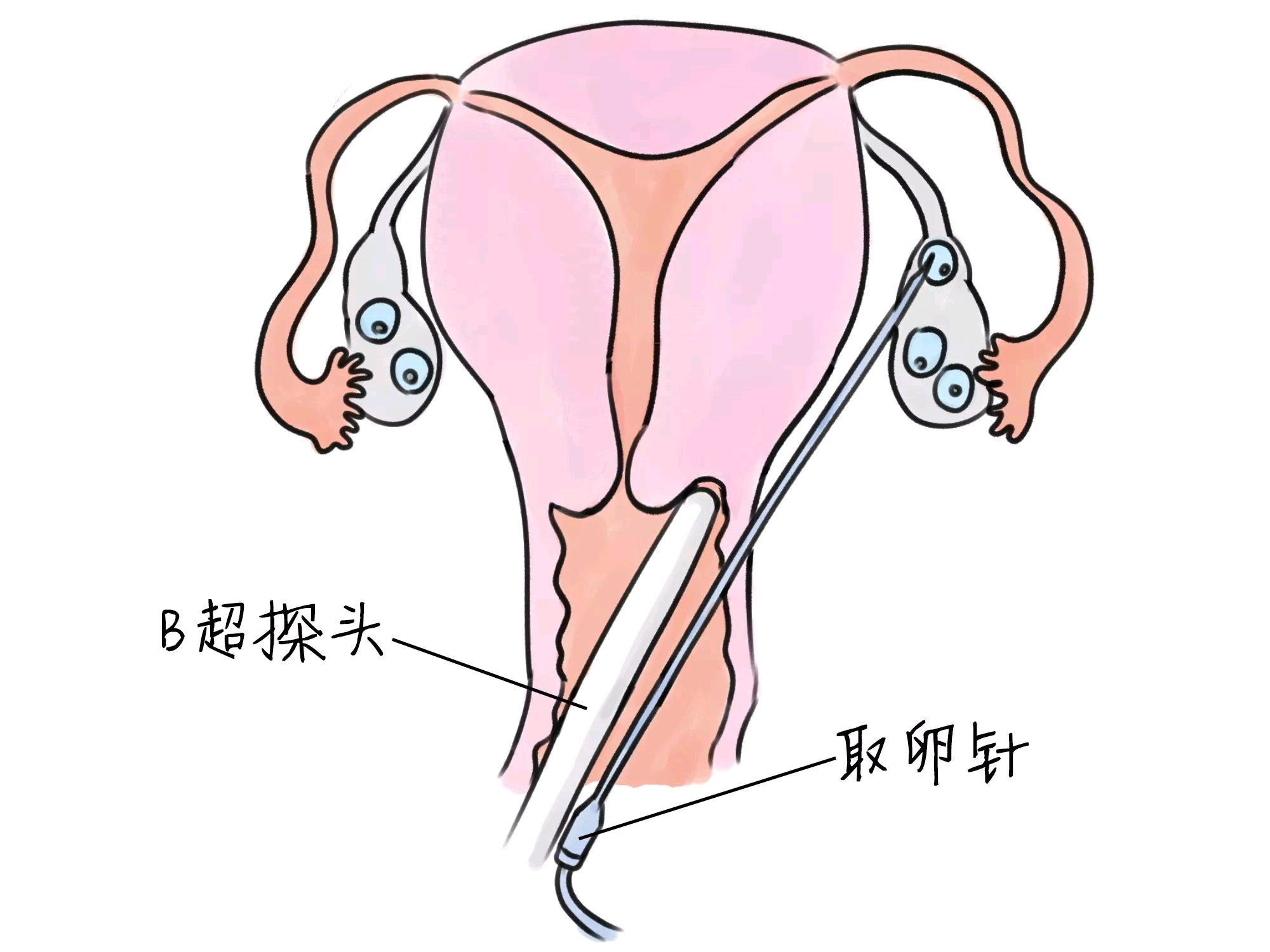 胚胎移植